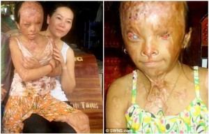 Monde: Une fille de 10 ans brulée avec de l’acide
